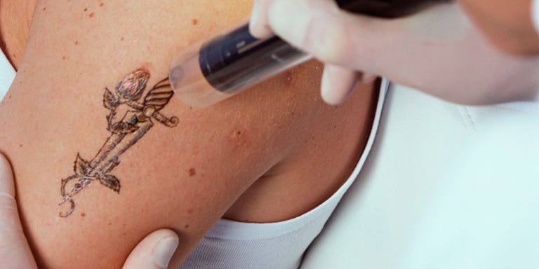 you need to know about laser tattoo removal you need to know about laser tattoo removal