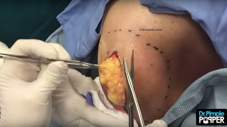 Watch Dr. Pimple Popper really go to town on this melon-sized fatty mass