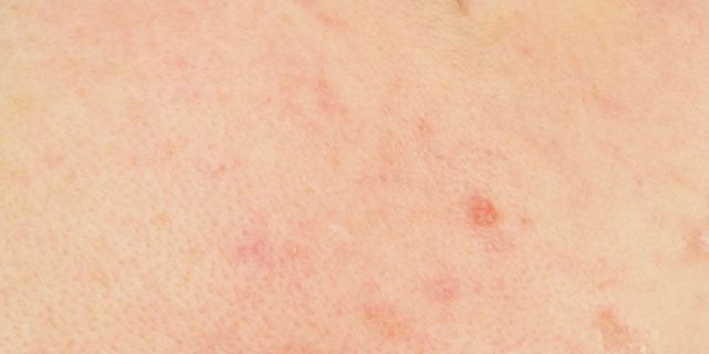 7 ways to bust acne for good