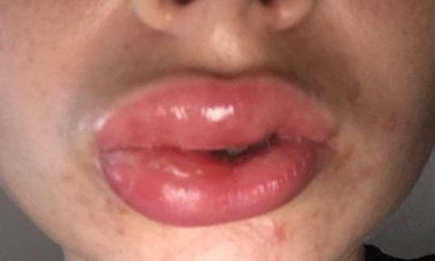 This woman's allergic reaction to a teeth-whitening session is terrifying