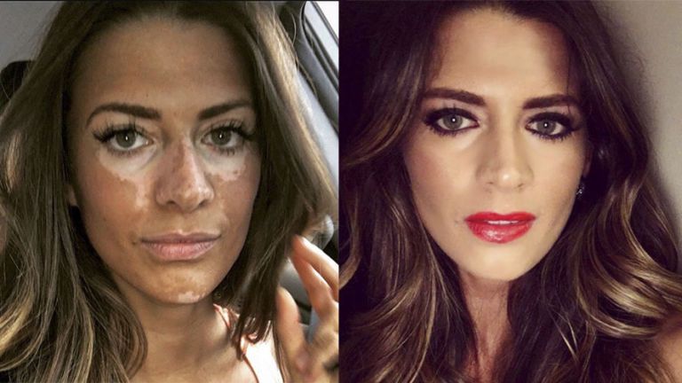 Model Who Hid Her Vitiligo For 10 Years