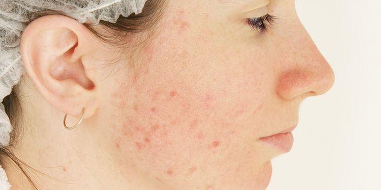 Foods that could help get rid of acne