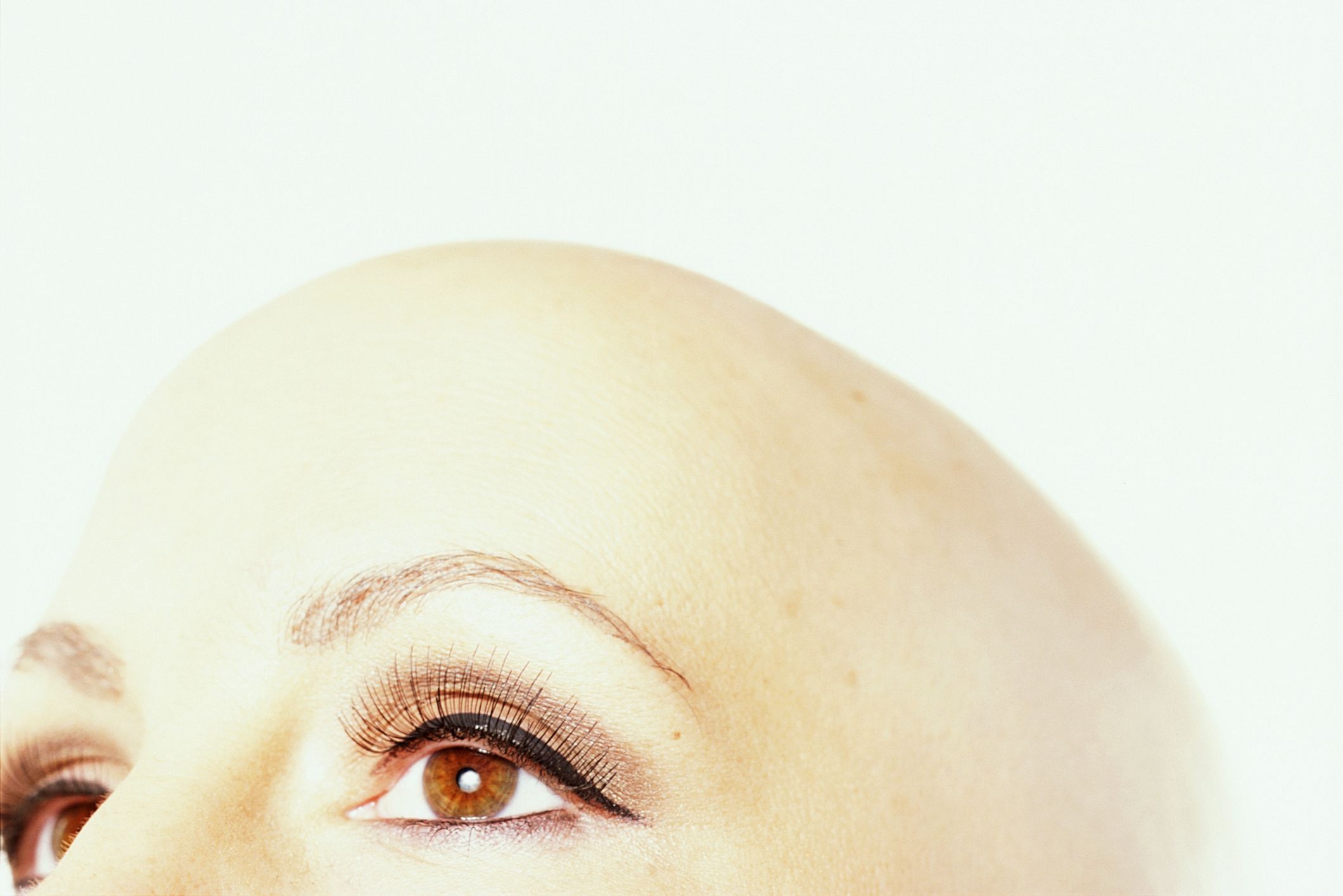 12 things you need to know about Alopecia