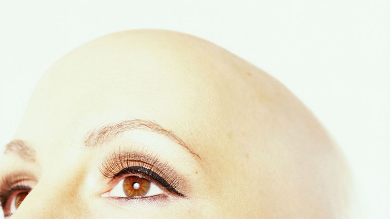 Scientists think they've discovered a cure for hair loss