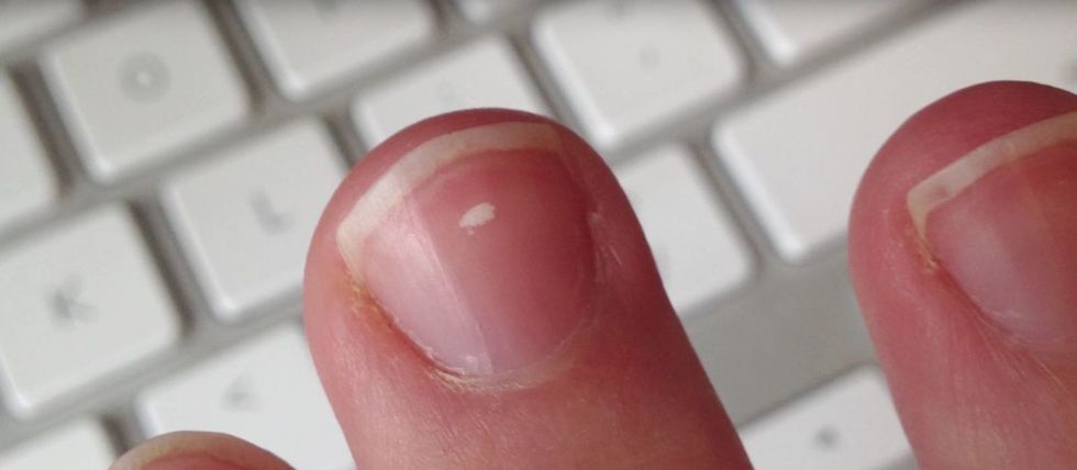 nail-white-marks-explained-thegreenbunk