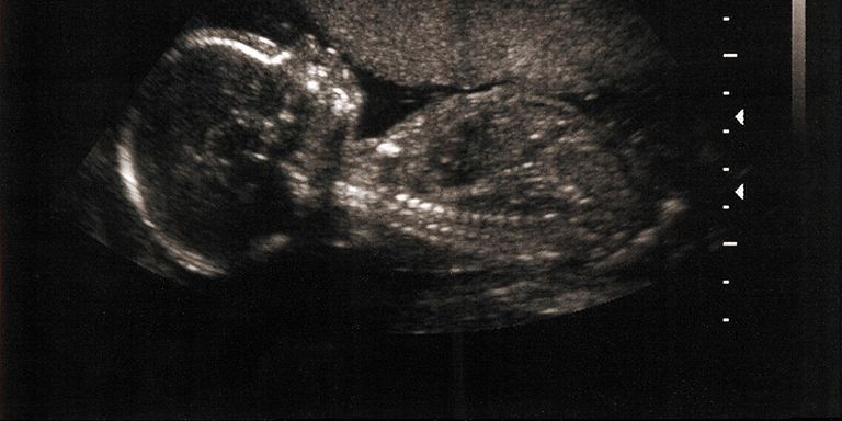ultrasound, abortion, baby, pregnancy, foetus