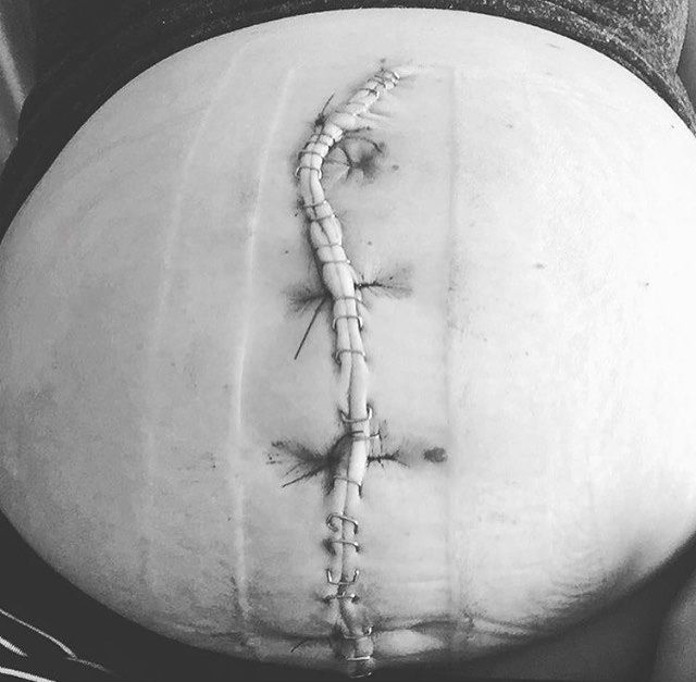 New mum posts raw photo of her C-section scar to shut up people who say she 'didn't give birth' properly