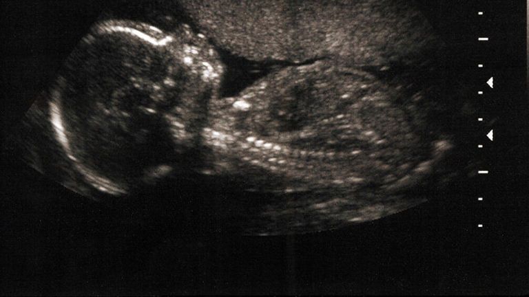 ultrasound, abortion, baby, pregnancy, foetus