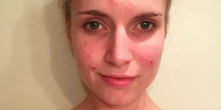 Blogger opens up about struggles with acne