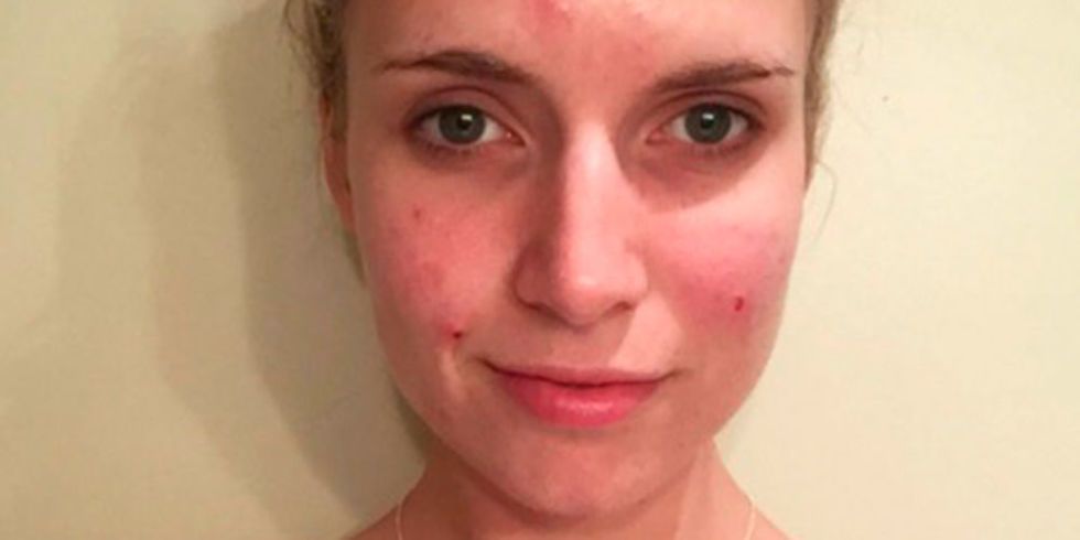 Fitness blogger posts Instagram essay about her struggles with acne