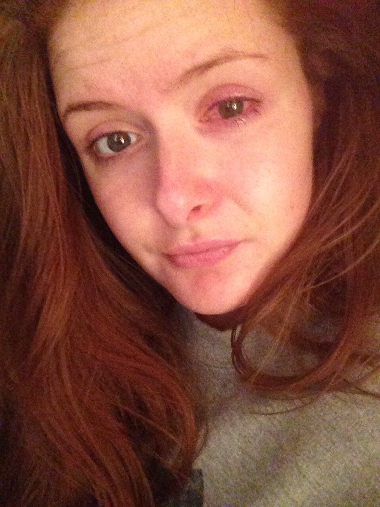 This woman ripped her cornea off after leaving her contact lenses in for 10 hours