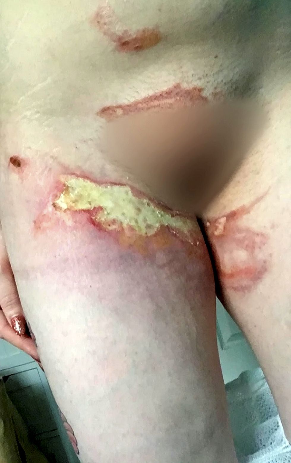 This woman dropped Costa Coffee on her lap and suffered third degree burns through her clothes