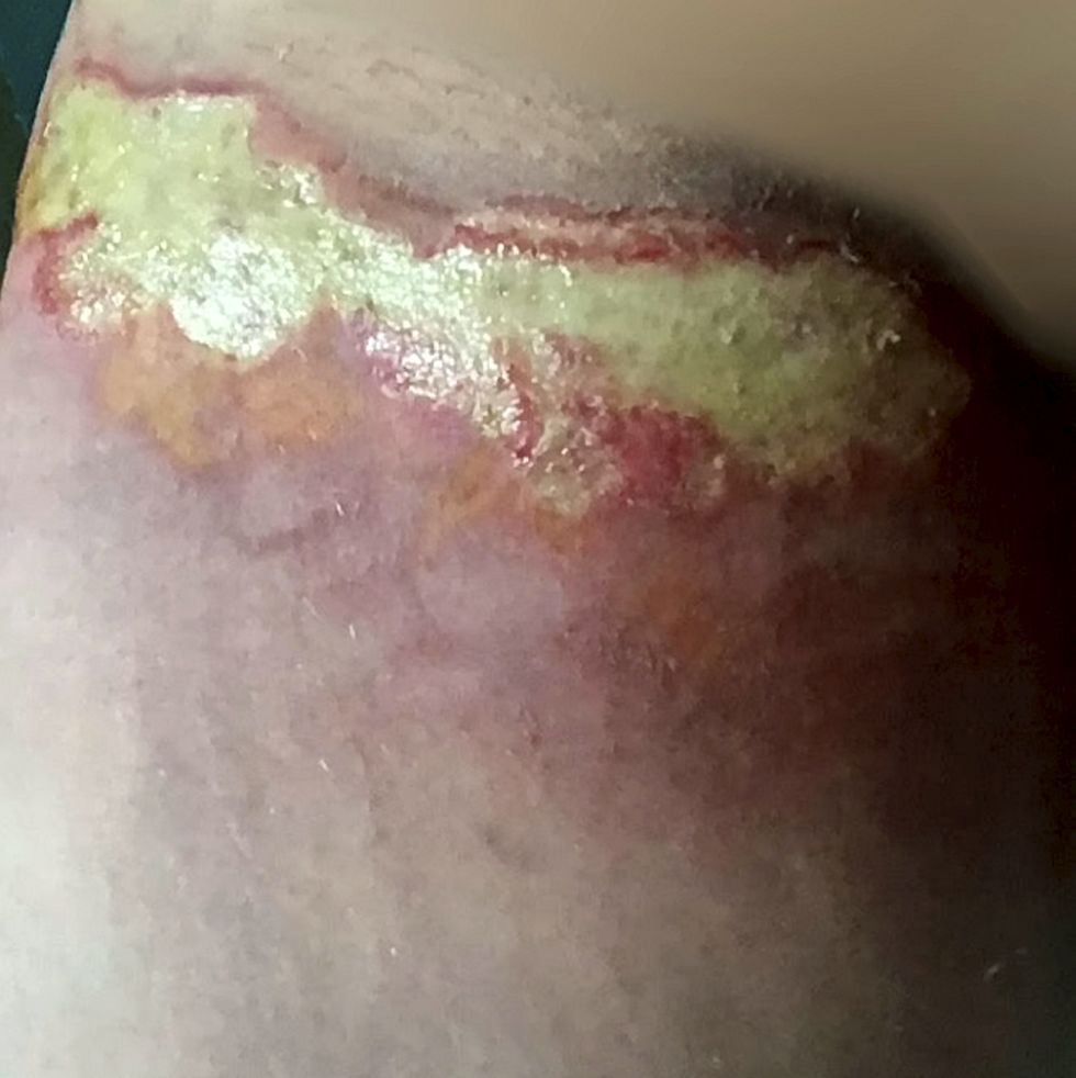 This woman dropped Costa Coffee on her lap and suffered third degree burns through her clothes
