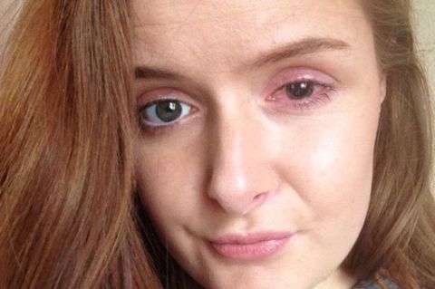 This woman ripped her cornea off after leaving her contact lenses in for 10 hours