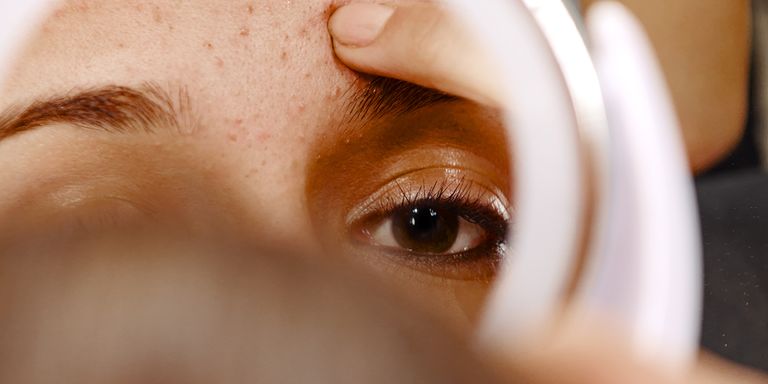 7 things your acne could mean
