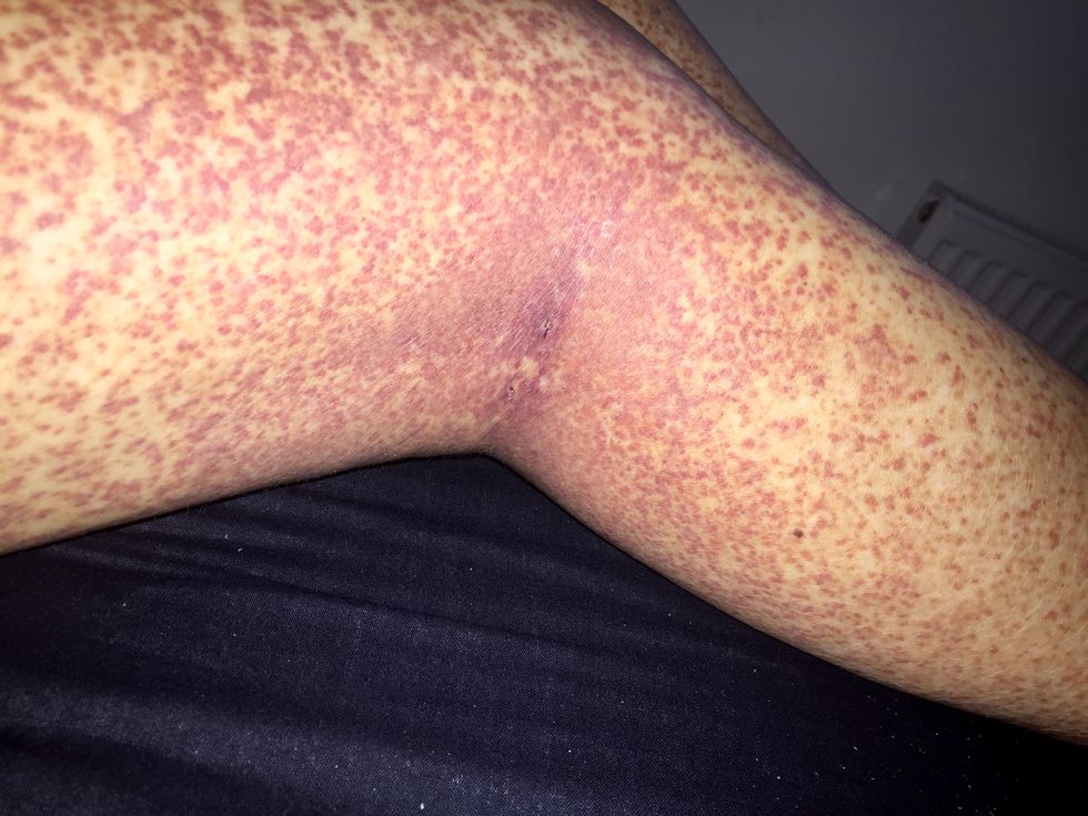This woman thought she had a shaving rash but it turned out to be cancer