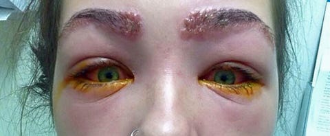 This girl was almost left blind after tinting her eyebrows at home