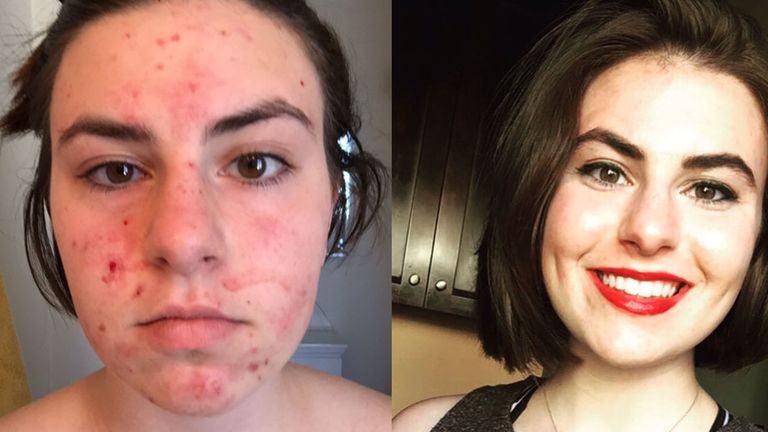 Woman's inspirational acne transformation