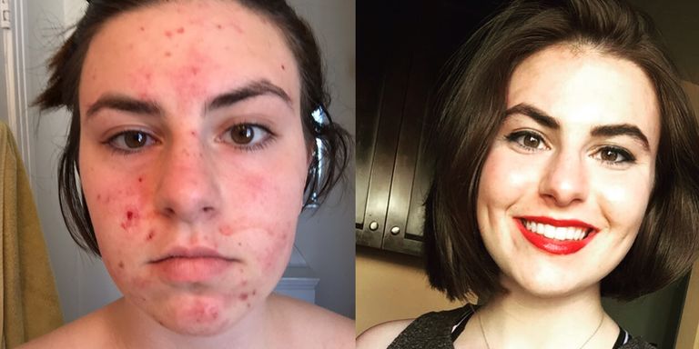 Woman's inspirational acne transformation