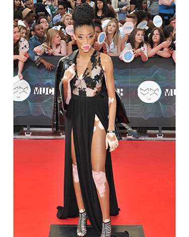 <p>We absolutely love how bold <em>America's Next Top Model</em> contestant Winnie Harlow has been with her dress here. Giving Kendall Jenner a run for her money in the slit dress stakes, Winnie has a point to prove and she does it well - her skin condition vitiligo isn't something to be hidden. It''s part of her and more than that - it's downright beautiful!</p>
<p><a href="http://www.cosmopolitan.co.uk/fashion/news/get-the-look-fearne-cotton-floral-dress" target="_blank">FEARNE COTTON'S GORGEOUS DRESS IS LESS THAN £30 ON THE HIGH STREET</a></p>
<p><a href="http://www.cosmopolitan.co.uk/fashion/news/swimwear-bikinis-small-busts-boobs" target="_blank">SUMMER SWIMWEAR FOR SMALL BREASTS</a></p>
<p><a href="http://www.cosmopolitan.co.uk/fashion/news/swimwear-bikinis-big-curvy-busts-boobs" target="_blank">SUMMER SWIMWEAR FOR BIG BREASTS</a></p>