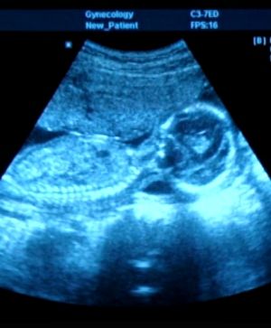 Obstetric ultrasonography, Medical imaging, Medical, Radiology, Medical radiography, Display device, 