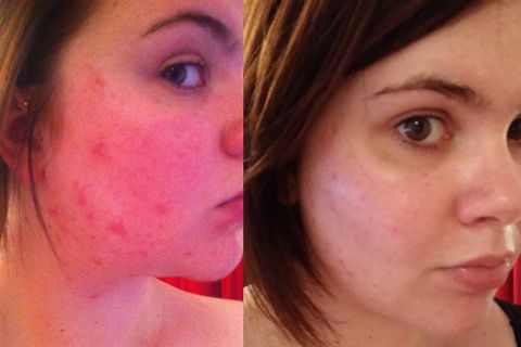 tack Permanent vinkel La Roche-Posay Effaclar Duo+ :: before and after pictures