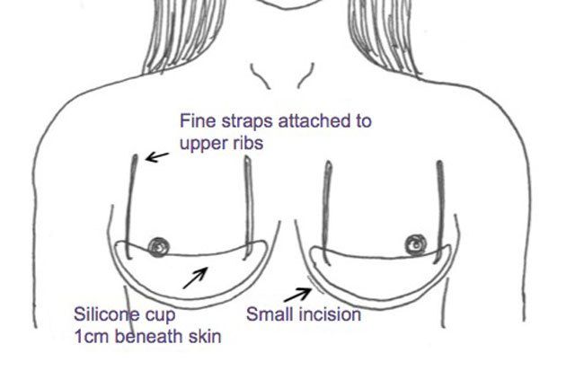 The internal bra can be used in many cases: supporting breast tissue,  holding up implants, or bringing implants closer together. The…