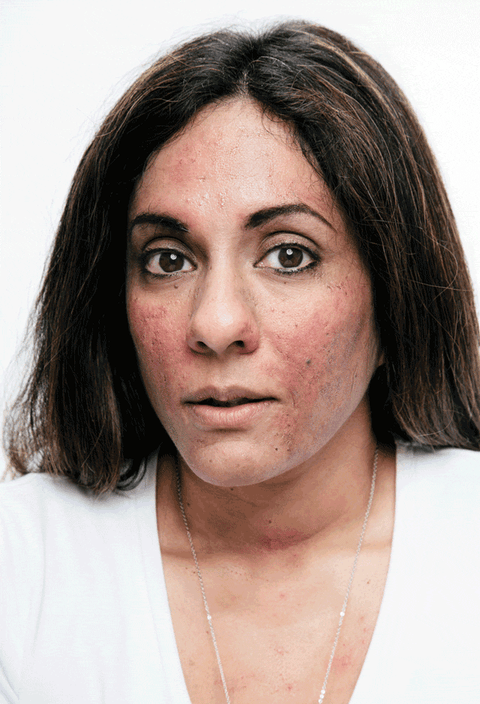 3 Brave Women With Skin Conditions - Cover Corrective Makeup For Rosacea 3 Brave Women With Skin Conditions - Cover Corrective Makeup For Rosacea