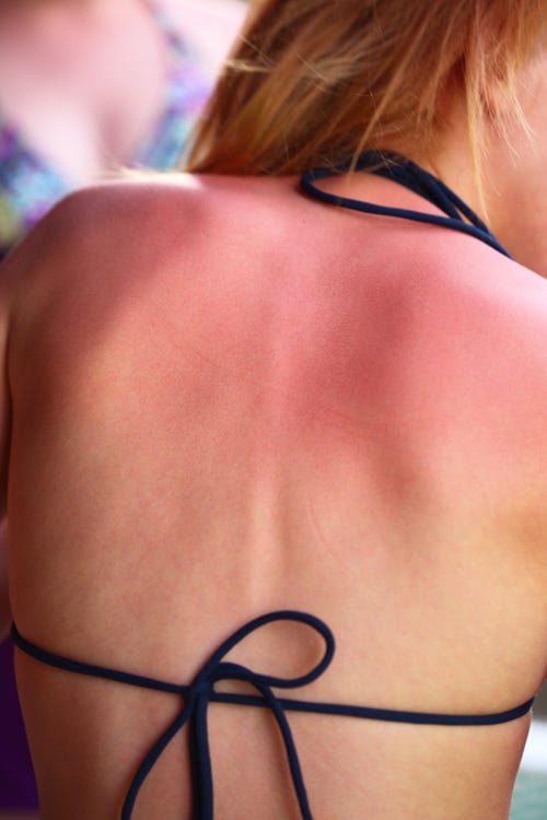 Hairstyle, Skin, Shoulder, Joint, Back, Organ, Undergarment, Neck, Muscle, Blond, 