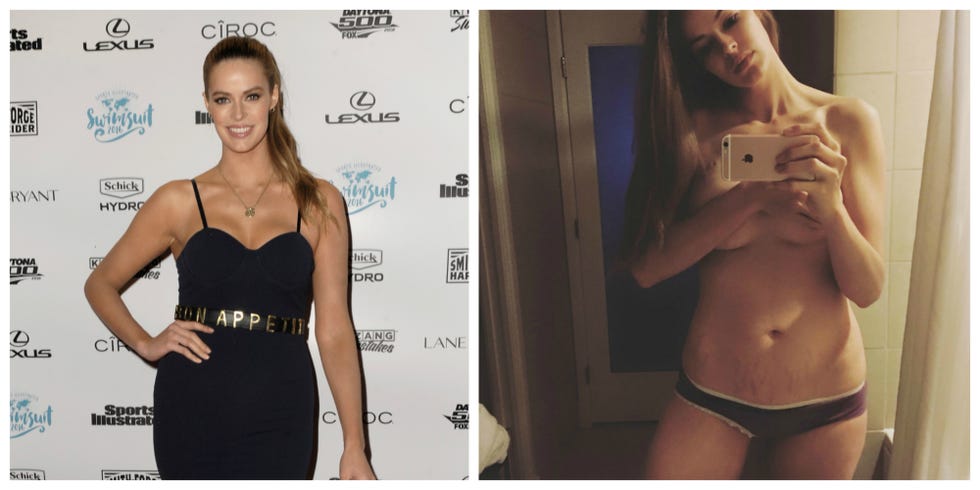 <p>The Australian <a href="http://www.redbookmag.com/body/news/a17894/plus-size-model-swimsuit-calendar/" target="_blank" data-tracking-id="recirc-text-link">plus-size <em data-redactor-tag="em">Sports Illustrated</em> model</a> posted this candid picture in response to a tabloid story published while she was pregnant claiming that she'd considered abortion in order to avoid stretch marks. She denounced the false story and spoke out about loving her #tigerstripes.
</p><p>"As for my stretch marks, I knew they were coming and as they're fading into white (like all my others) I thought I might capture them. Because they are some bad ass <span class="_5afx" data-verified="redactor" data-redactor-tag="span" data-redactor-class="_5afx"><span class="_58cl _5afz" data-verified="redactor" data-redactor-tag="span" data-redactor-class="_58cl _5afz">#</span><span class="_58cm" data-verified="redactor" data-redactor-tag="span" data-redactor-class="_58cm">tigerstripes</span></span>. And I earned them," <a href="https://www.facebook.com/175775249378/photos/a.10150208136009379.331958.175775249378/10153779423284379/?type=3&amp;theater" target="_blank" data-tracking-id="recirc-text-link">Lawley captioned her Facebook post</a>. "We put an unbelievable amount of ridiculous, time-consuming pressure on women to care so much about their flaws they forget how truly beautiful they (you) are today."<span data-redactor-tag="span" data-verified="redactor"></span></p>