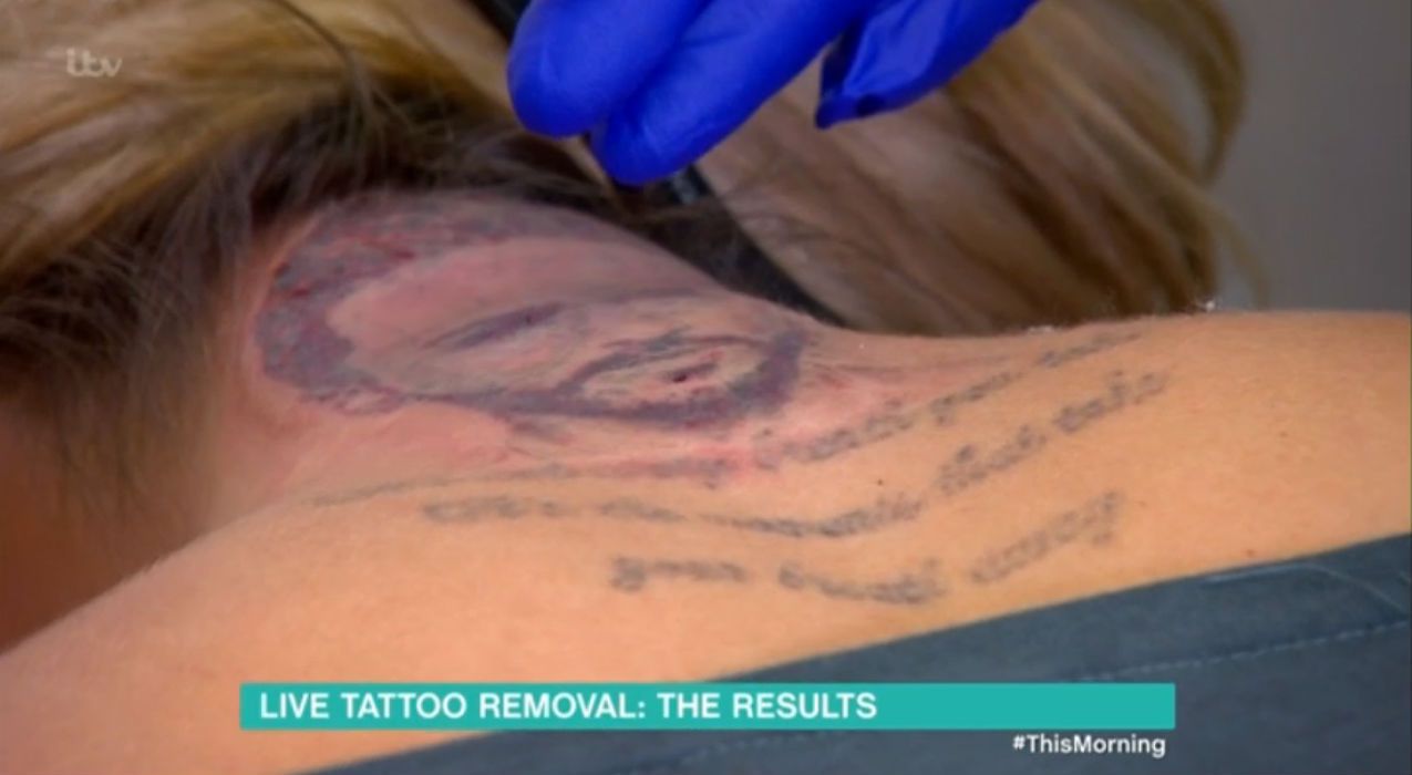Blog Envision Laser Removal Laser Tattoo Removal Specialists Port  Charlotte FL