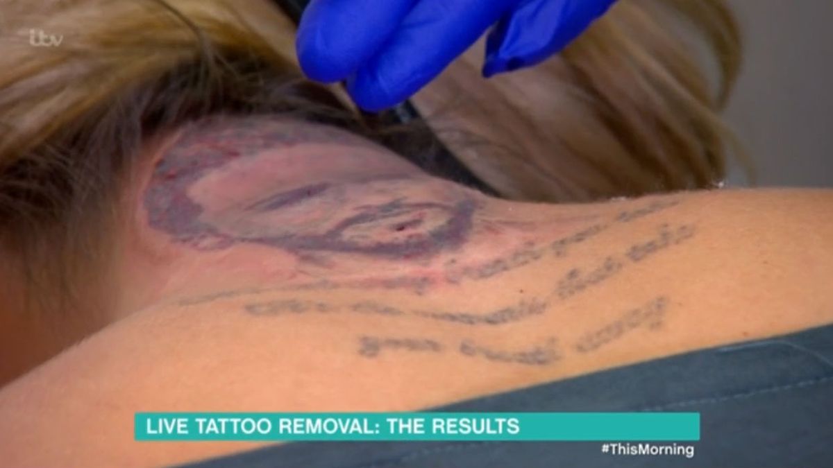 Holly Hagan undergoes tattoo removal procedure