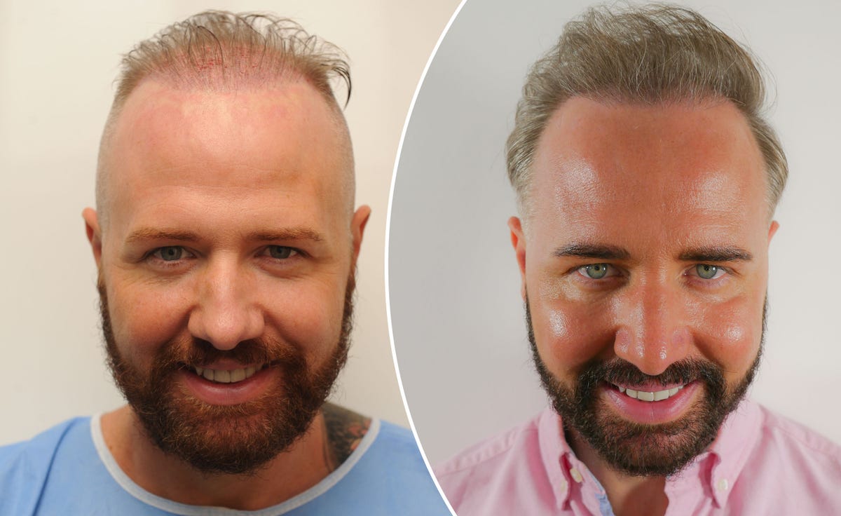 Gogglebox's Chris Steed reveals dramatic £8,000 hair transplant