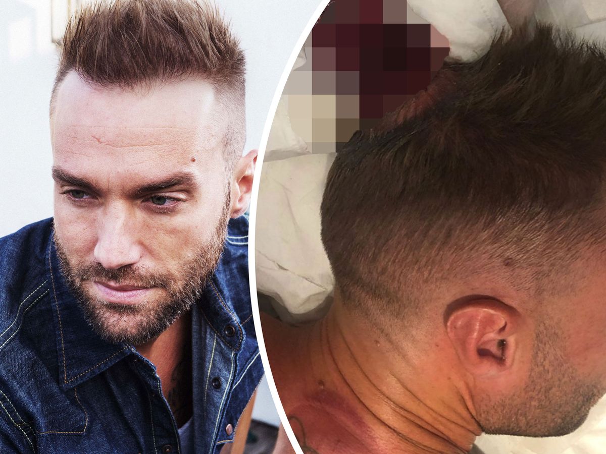 Calum Best reveals graphic results of extreme cupping procedure that leaves  him bleeding from the head