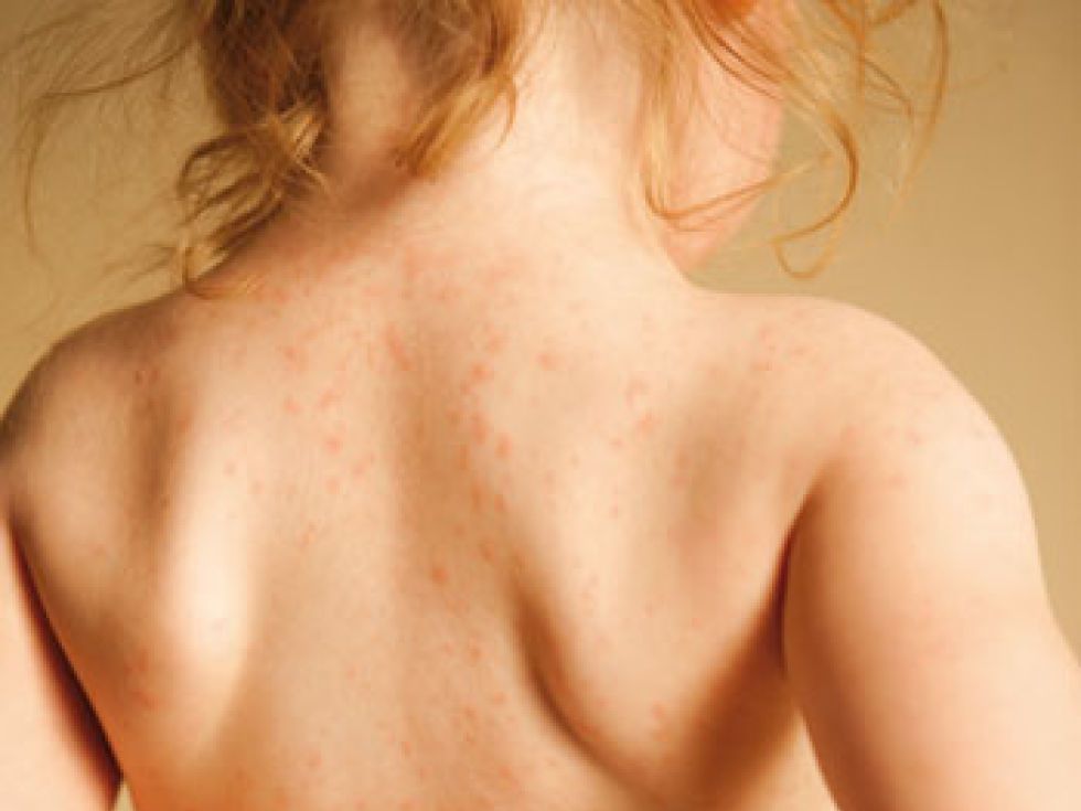 Есть ли аллергия на гречку. Аллергия на пшеничную муку. Аллергия на финики у ребенка. Проявление аллергии на мучном.