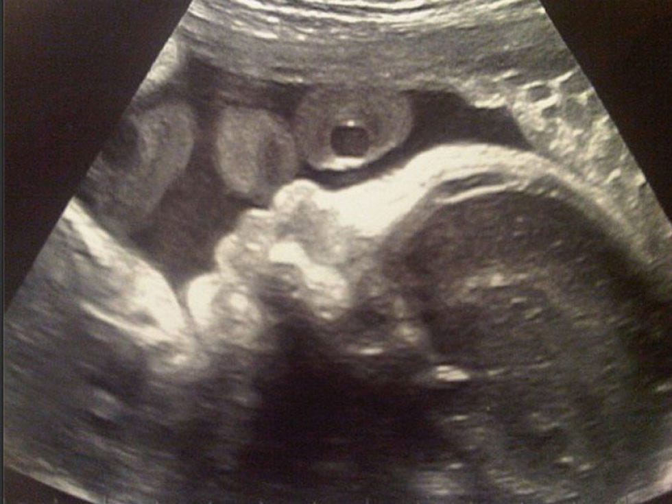 Obstetric ultrasonography, Medical imaging, Monochrome photography, Black-and-white, Medical, Medical radiography, Monochrome, Radiology, 