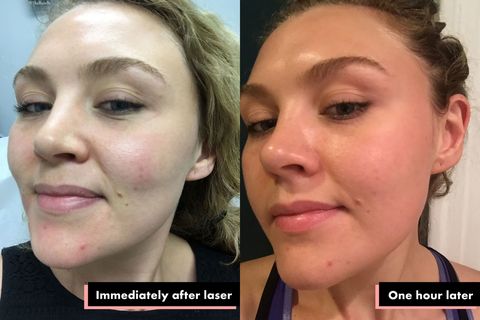 What Happens When You Get Laser Treatments For Acne Scars
