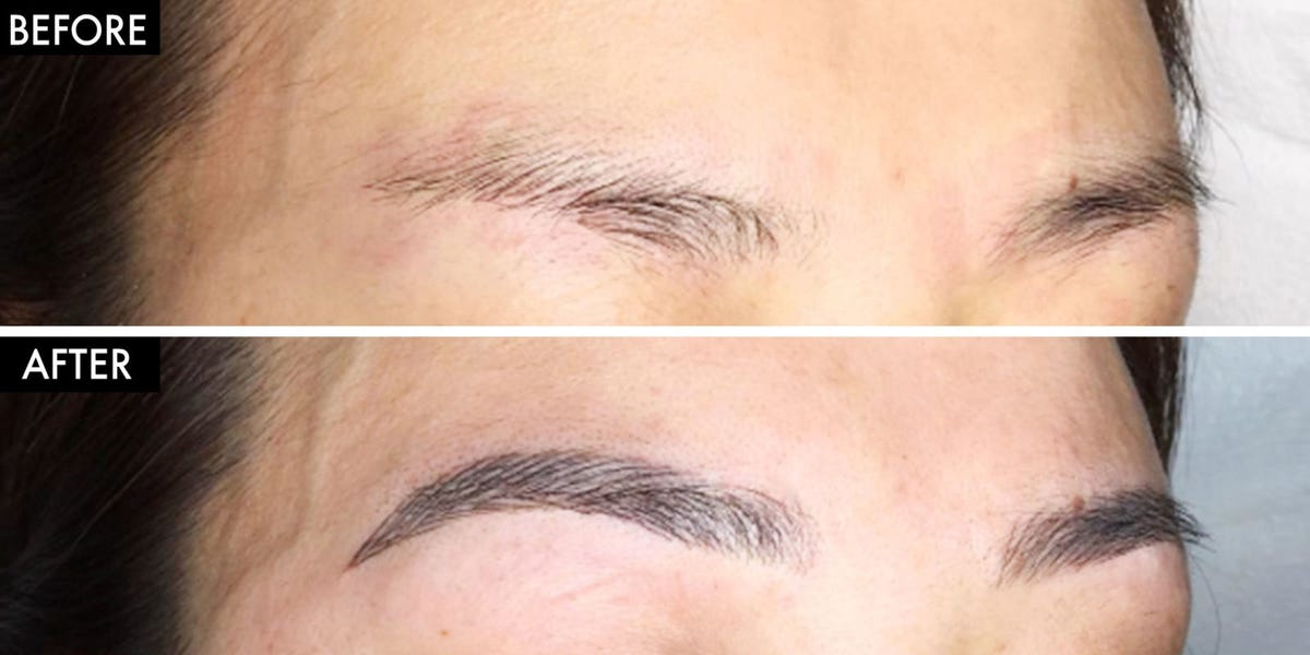 Cat Eye Removal Aftercare Cat Eye Removal Aftercare