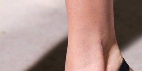 Varicoză pe picioare este tratată Cauza apariiei varicozelor tratamentul varicozei