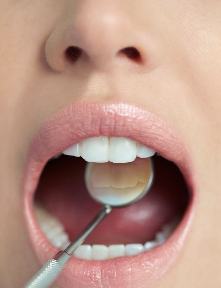 <p>La Ortodoncia Lingual es un tratamiento para conseguir el alineamiento de los dientes y su correcta oclusión, mediante la colocación, sin molestias y sin afectar el habla, de los brackets en la cara interna de los dientes, por lo que se hace invisible, frente a la Ortodoncia Vestibular convencional, en la que los brackets se sitúan en la cara externa del diente, según explica la <strong>Dra. Dolores Oteo Calatayud</strong>, vocal de Ortodoncia del Colegio de Odontólogos y Estomatólogos de Madrid (<a href="http://www.coem.org.es/" target="_blank">www.coem.org.es</a>).</p><p>Hasta hace poco tiempo el arco de alambre que se colocaba debía llevar varios dobleces y los brackets eran de gran tamaño, lo cual resultaba incómodo para el paciente. Pues bien, gracias a la tecnología digital 3D, ahora “se consigue el alineamiento de los dientes con una gran precisión, mediante una colocación específica de brackets de reducido tamaño, muy cerca del diente, y la utilización de un arco sin dobleces totalmente liso”, según cuenta la experta. Con la gran ventaja de que al ponerse lingualmente los brackets no se ven en ningún momento del tratamiento. <strong>Precio:</strong> Presupuesto personalizado. <strong>Más info</strong>: COEM (Madrid, tel. 915 61 29 05).</p>