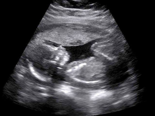 Obstetric ultrasonography, Medical imaging, Monochrome photography, Monochrome, Black-and-white, Medical, Radiology, Medical radiography, 