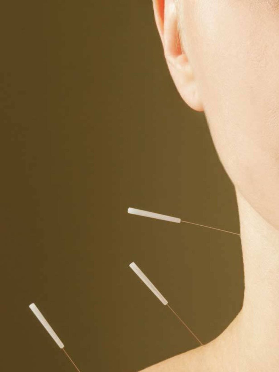 <p><strong>Acupuncture </strong></p><p>Acupuncture is a form of Chinese medicine that stimulates points on the body that are associated with the flow of energy, also know as qi (pronounced chee), with hair thin needles. It is believed that an imbalance 