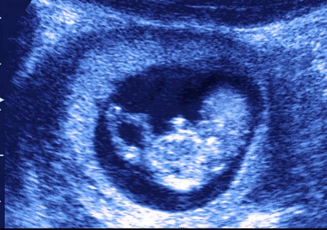 Obstetric ultrasonography, Colorfulness, Medical imaging, Electric blue, Medical, Radiology, Medical radiography, 