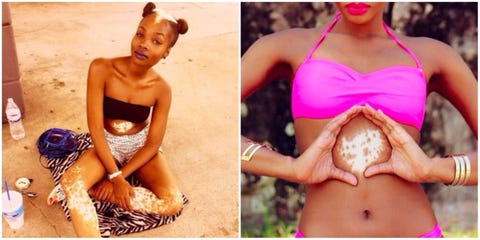 Model Once Nicknamed Skunk With Rare Vitiligo Like Skin