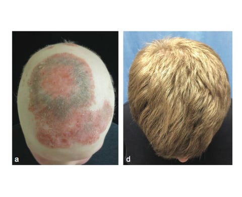 Bald Men Grow Thick Heads of Hair in Yale Study