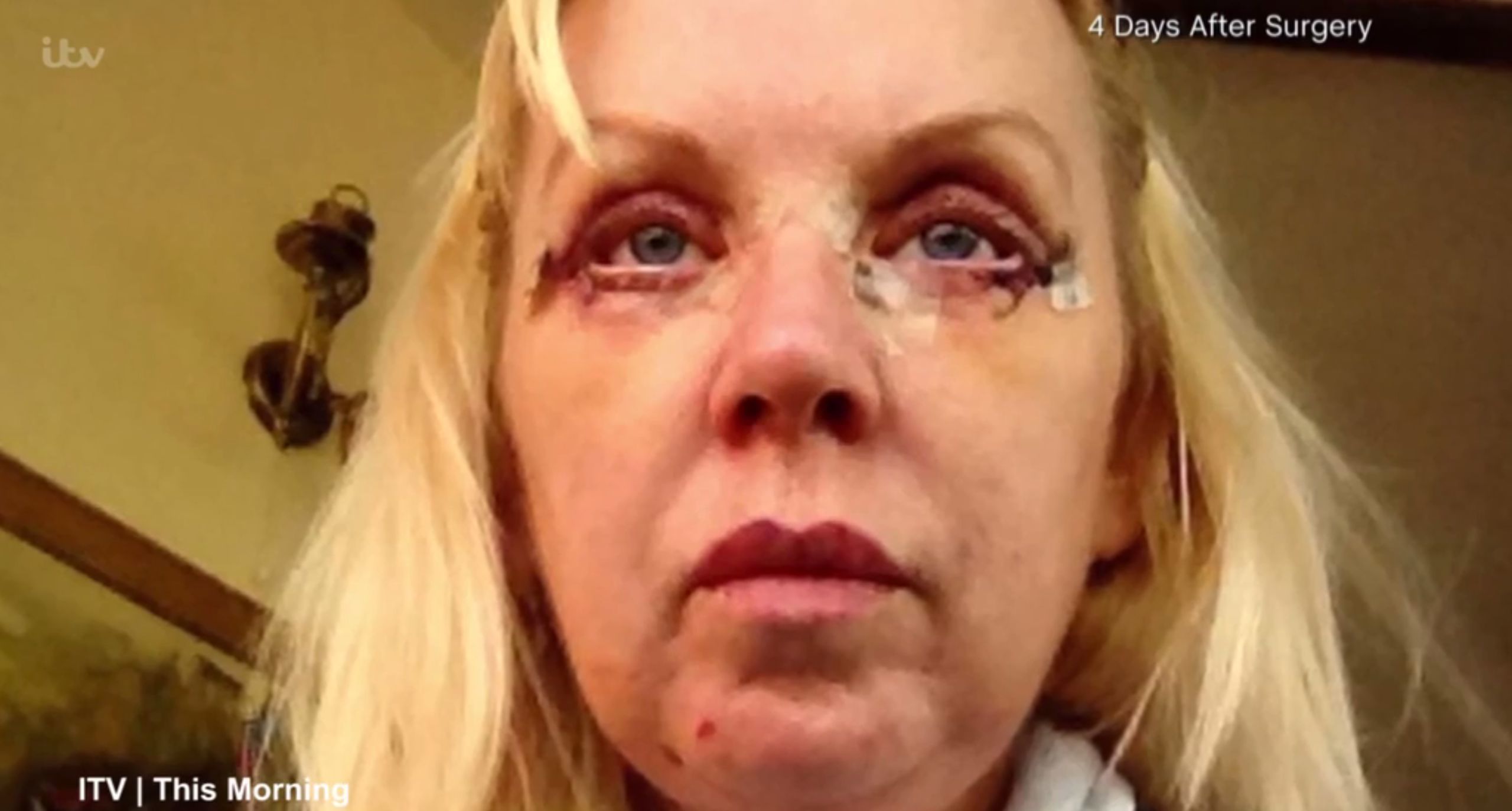 eyelid surgery gone wrong