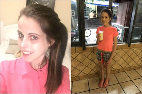 Woman Battling Bulimia Could Die By Age 30 — Charlene Roberts Severe