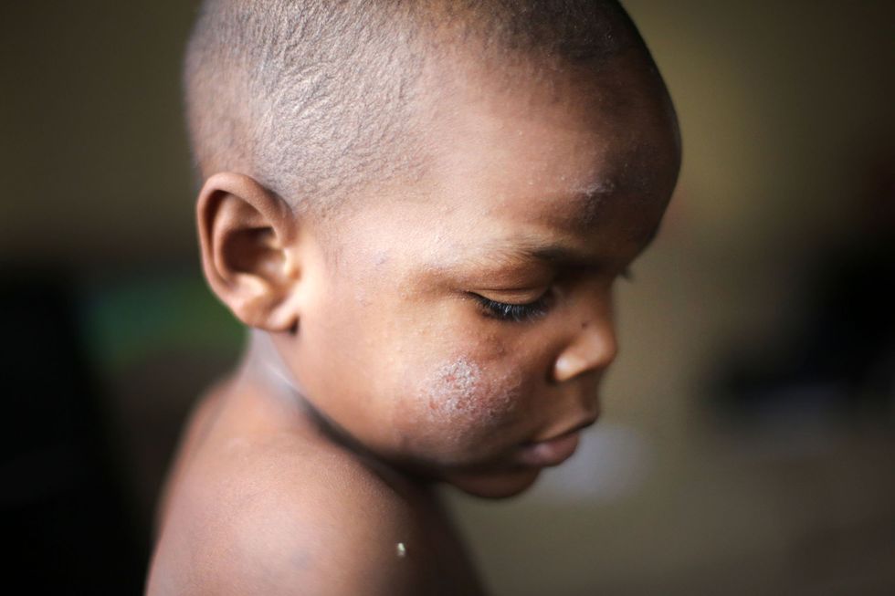  Jan. 13, 2016 - Michigan, MI, U.S. - Sincere Smith 2, of Flint is one of  three children living with his single mom Ariana Hawk, 25. He is suffering from severe skin rash issues his mother believes are due to bathing in the contaminated Flint water. His mom no longer bathes him in the tap water. He is on medication to help with this extreme eczema. His skin is raised, itchy and even a bit painful. He is constantly uncomfortable. The discomfort causes his entire family to stress when he is stressed. The sight of water often causes the 2-year-old to break down or retreat to himself. His mom now bathes him with bottled water. Not only is this inconvenient , it  is quite costly. She says she is spending at least 7.00 a week on just water for her family. She cannot afford to have bills likes this. He is photographed at his Flint home Wednesday, Jan. 13, 2016.