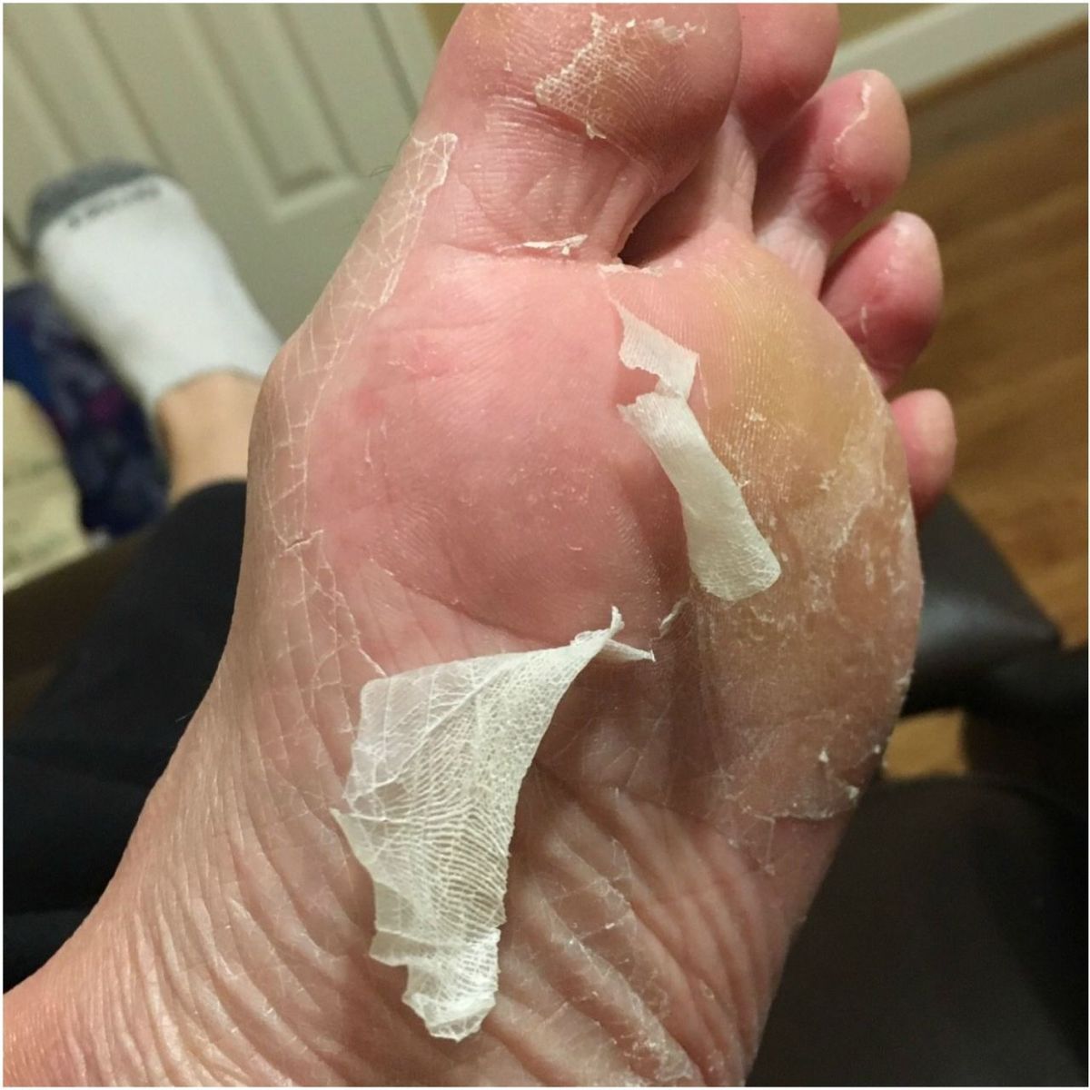 Does the Baby Foot Peel Live Up to the Hype?