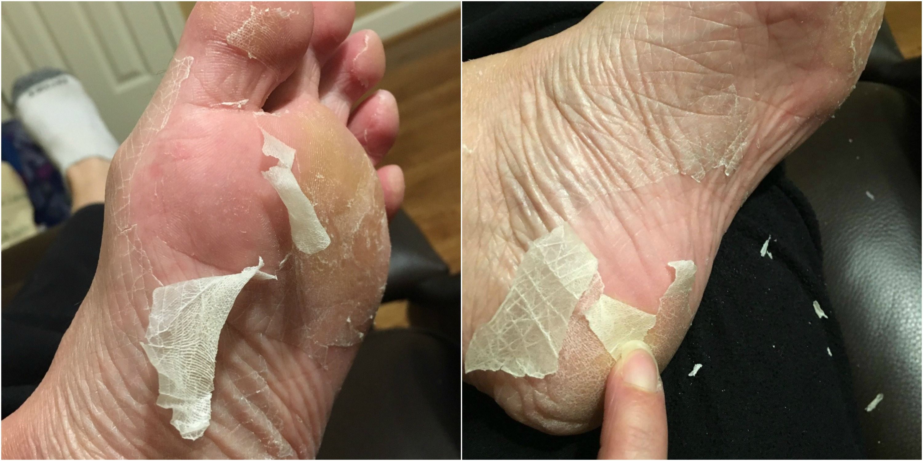 diy dead skin foot peel